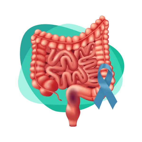 Imagen principal Cáncer de Colon