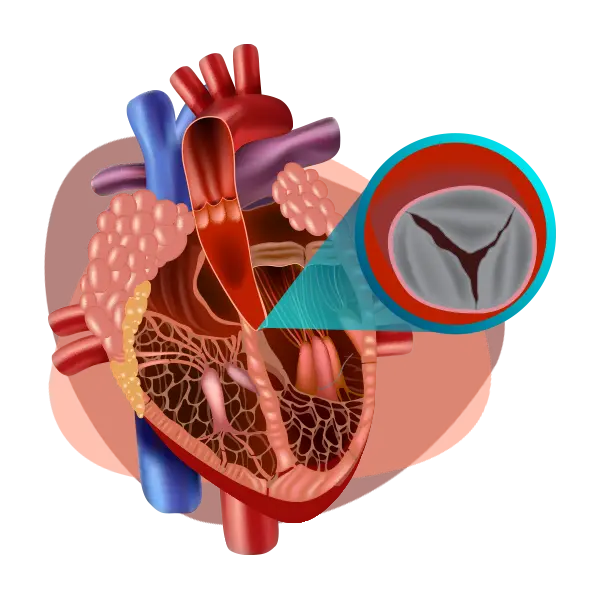 Imagen principal Estenosis Aórtica